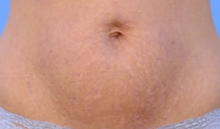 Stretch marks removed, Marquis Plastic Surgery, Coral Gables, Miami, West Palm Beach, FL.