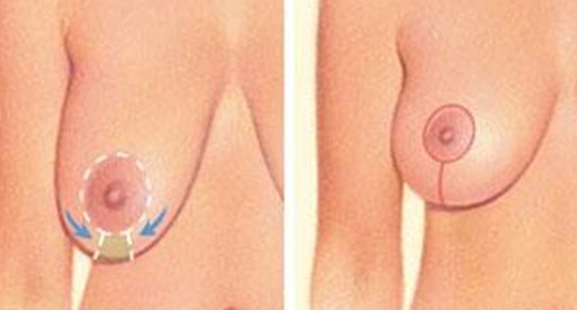 Image, illustration, of a vertical breast lift. Photo for Marquis Plastic Surgery, Coral Gables, Miami, West Palm Beach, Florida.