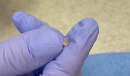 Image of silicone oil encapsulated by the body, Dr. Arthur E. Desrosiers, Marquis Plastic Surgery, Miami, Coral Gables, West Palm Beach, Florida.