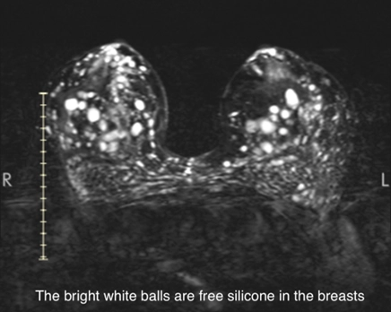 Bright white balls are free liquid silicone in the breasts. Marquis Plastic Surgery, Miami, FL.