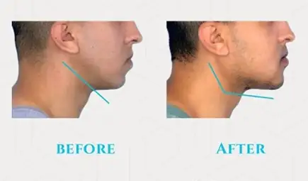 Before and after jaw and chin implant, Marquis Plastic Surgery, Miami, FL.