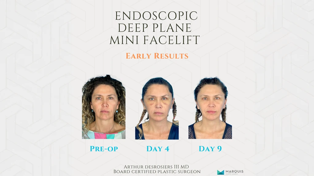 Endoscopic Deep Plane Mini Facelift, for Marquis Plastic Surgery, Miami, FL.