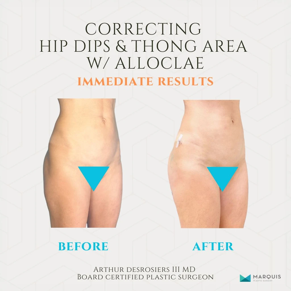 Before and after alloClae injections for hip dip and thong area correction performed by Dr. Arthur Desrosiers III MD at Marquis Plastic Surgery.
