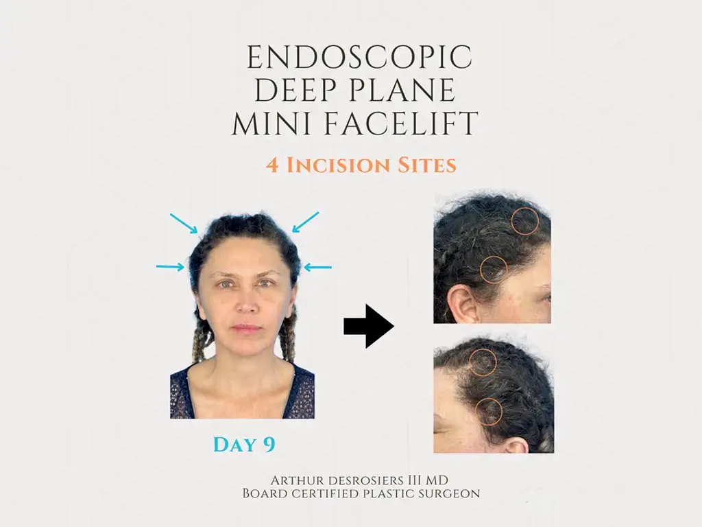 Day 9 endoscopic deep plane mini facelift showing 4 hidden hairline incisions by Dr. Arthur Desrosiers.