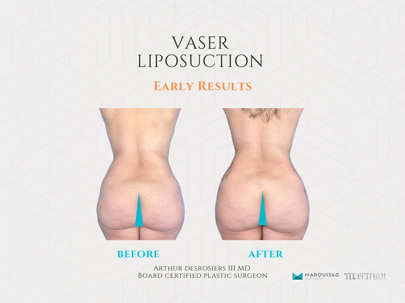 Before and after Vaser liposuction results on a patient's back at Marquis Plastic Surgery, Miami.