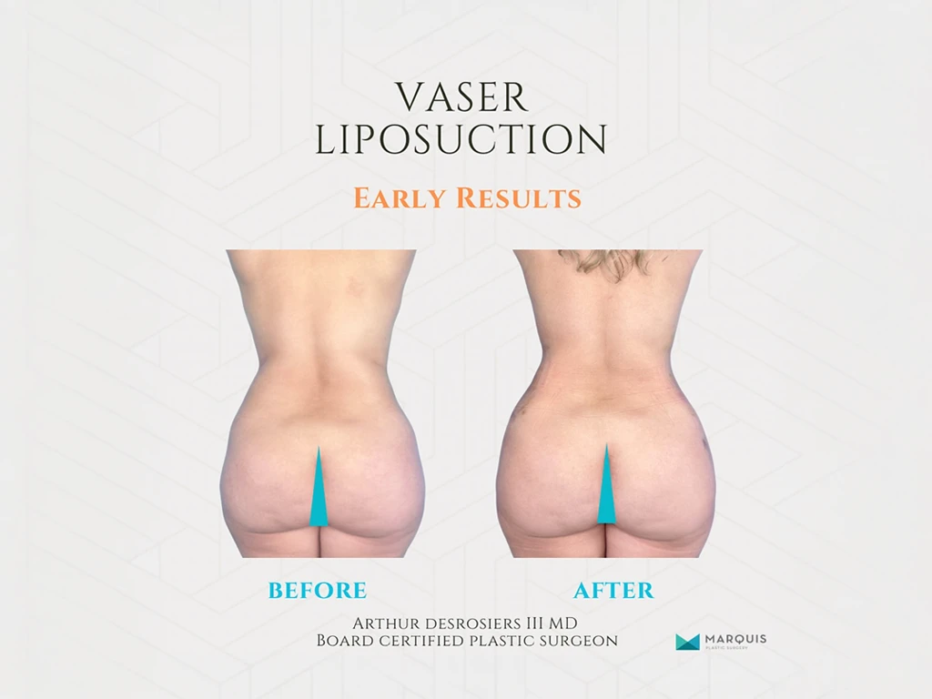 Before and after Vaser liposuction results on a patient's back at Marquis Plastic Surgery, Miami.
