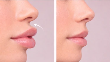 Profile view comparing anteriorly projected lips with a flat lip profile for aesthetic filler treatments.