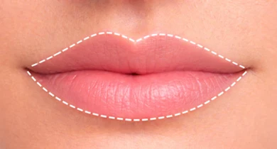 Close-up with dashed lines tracing the lip's vermilion border, illustrating boundaries for precise lip injections.